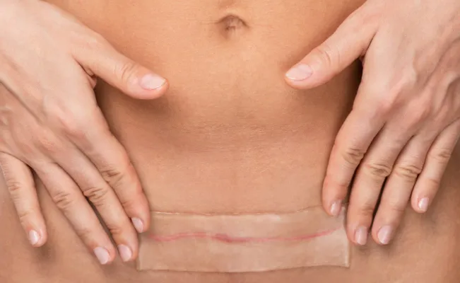 Horizontal cesarean section incision scar healing with bandage showing bikini cut c-section recovery.